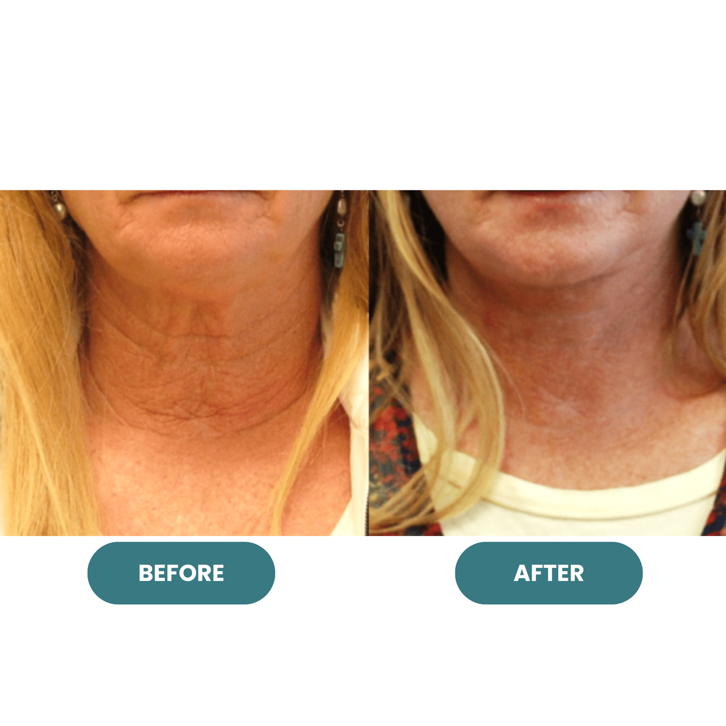 Crepey Skin Repair Cream
